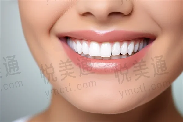 北京合众齿科门诊部推出牙齿美白优惠活动，原价980元起现仅需680元起，助您轻松拥有迷人亮白笑容！