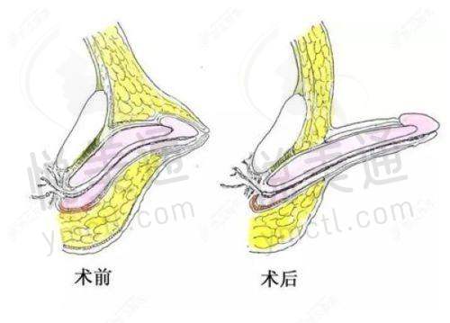 眼睛修复手术保护