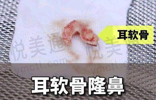 郑州壹加壹医疗美容医院正规连锁服务好，王洛生医生技术佳，眼胸整形值得做
